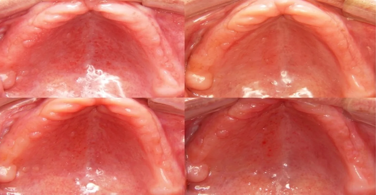 Denture Stomatitis 2
